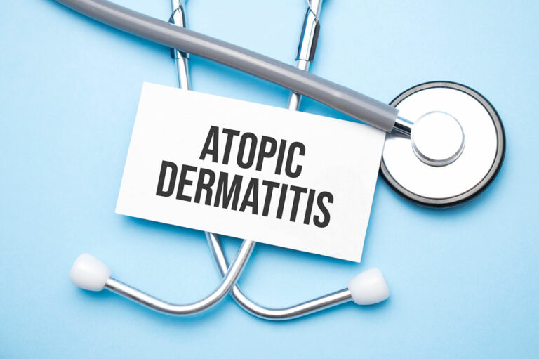 Atopic Dermatitis – Symptoms, Causes, and Remedies